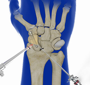 Arthroscopic Partial Wrist Fusion