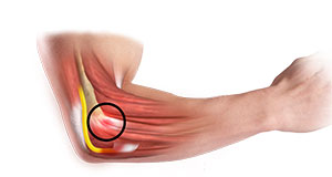 Common Extensor Tendon Origin Repair