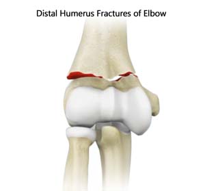 ORIF of the Distal Humerus Fractures