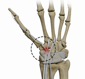 Distal Intersection Syndrome
