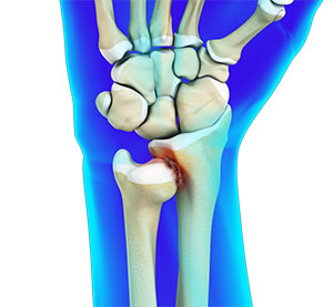 Distal Radioulnar Joint (DRUJ) Arthritis