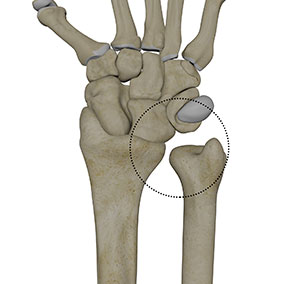 Distal Radioulnar Joint (DRUJ) Instability