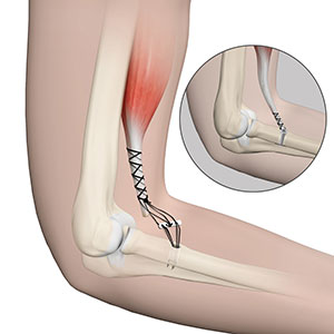 Elbow Tendon & Ligament Repair