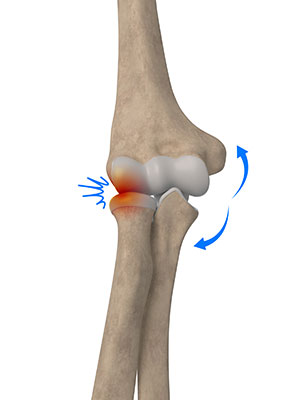 Lateral Impingement of the Elbow