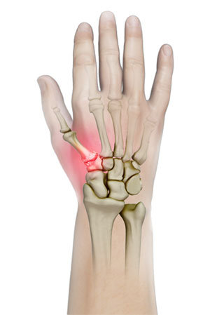 LRTI (Ligament Reconstruction and Tendon Interposition) for Thumb CMC Arthritis