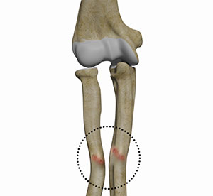 Malunion Surgery (Elbow)