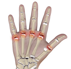 Metacarpophalangeal Joint Arthritis