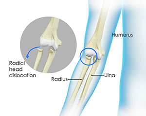 Elbow Contracture