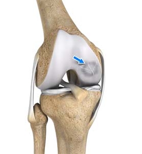 Osteochondritis Dissecans of Elbow