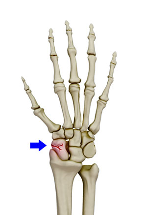 Scaphoid Facture