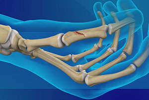 Thumb Fracture