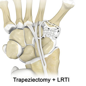 Trapeziectomy