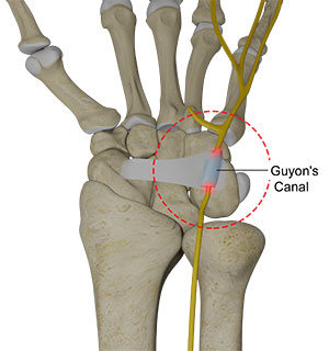 Ulnar Nerve Compression in Guyon's Canal