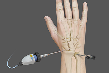 Wrist Arthroscopy