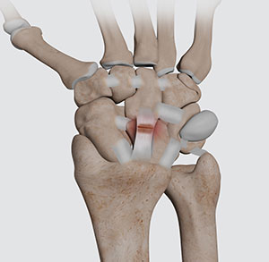 Wrist Ligament Tear and Instability