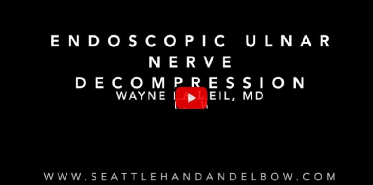 Endoscopic Ulnar Nerve Decompression
