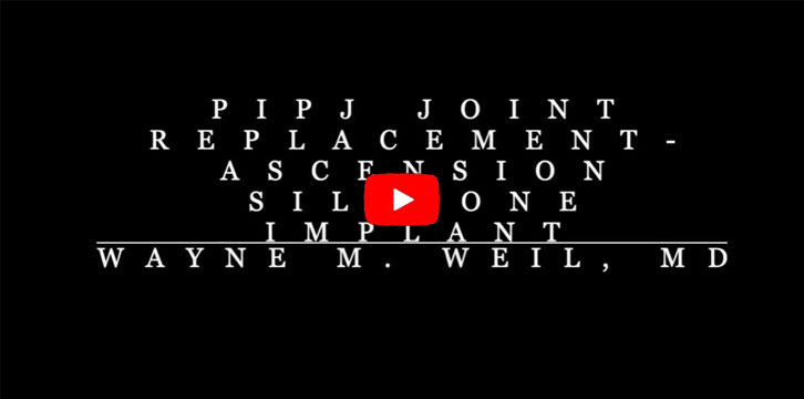 Finger Joint Replacement