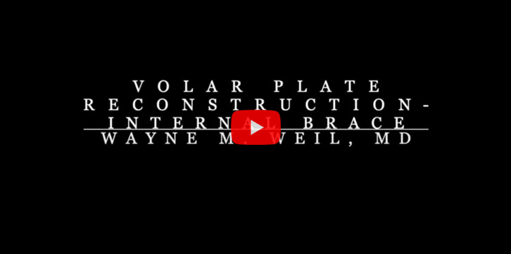 Volar Plate Reconstruction with Internal Brace